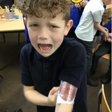 Y3 Burns and Scalds 1