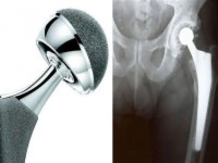 Hip Replacement